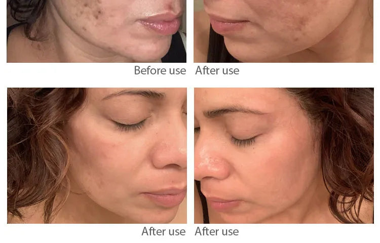 kraftvolle-krauteraufhellung-sommersprossencreme-akne-dunkle-flecken-melanin-verblassen-melasma-anti-pigmentierung-stumpfheit-brightenface