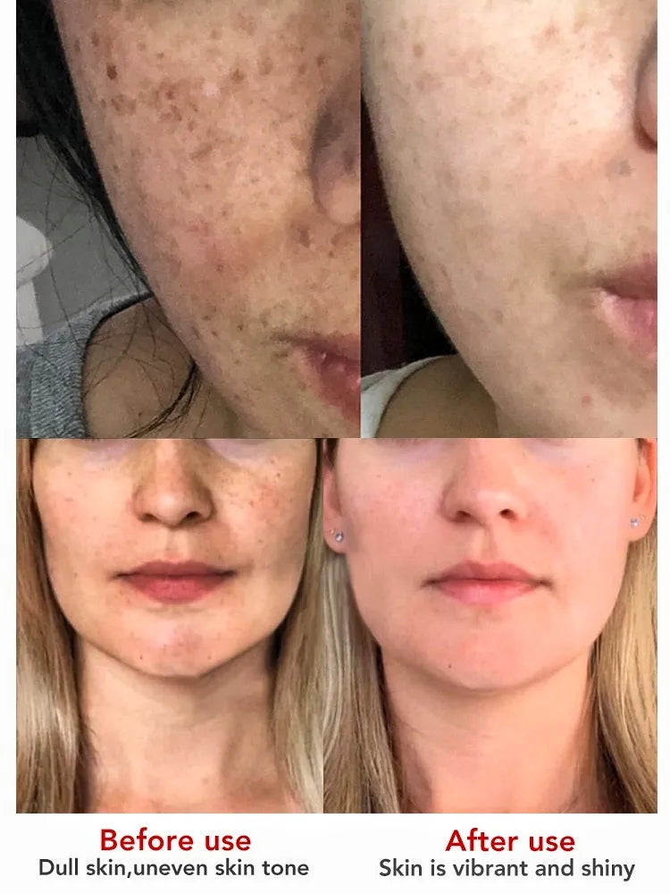 kraftvolle-krauteraufhellung-sommersprossencreme-akne-dunkle-flecken-melanin-verblassen-melasma-anti-pigmentierung-stumpfheit-brightenface