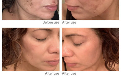 kraftvolle-krauteraufhellung-sommersprossencreme-akne-dunkle-flecken-melanin-verblassen-melasma-anti-pigmentierung-stumpfheit-brightenface