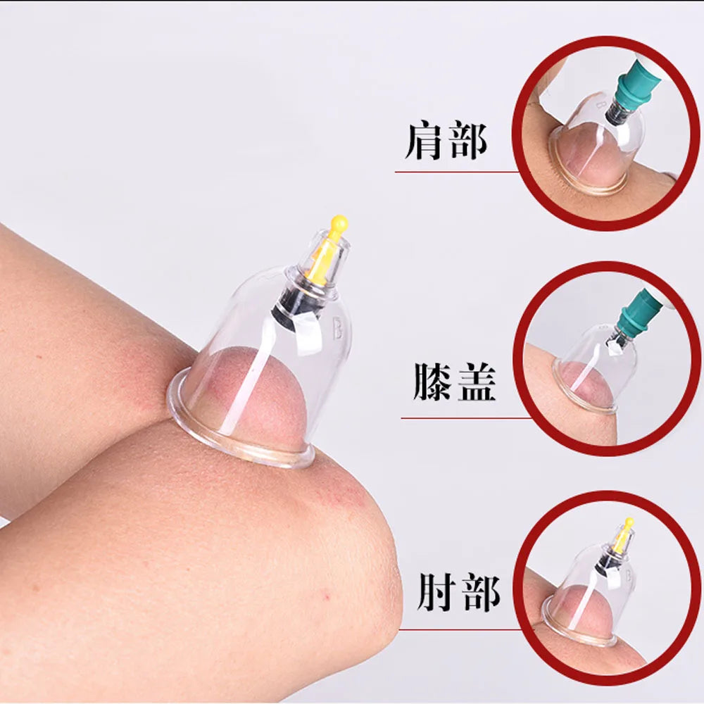 Vakuum-Schröpfset, Saugnäpfe für Akupunkturmassage, chinesische Medizin, Fettverbrennungstherapie, Körpermassage, Schröpfen zur Gewichtsreduktion